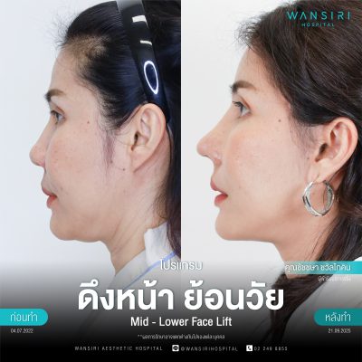 ดึงหน้า, ดึงหน้า ชั้นลึก, Face Lift, Deep Plane Facelift, Neck Lift