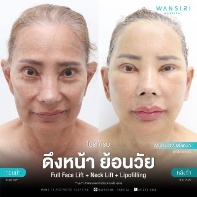 ดึงหน้า, ดึงหน้า ชั้นลึก, Face Lift, Deep Plane Facelift, Neck Lift