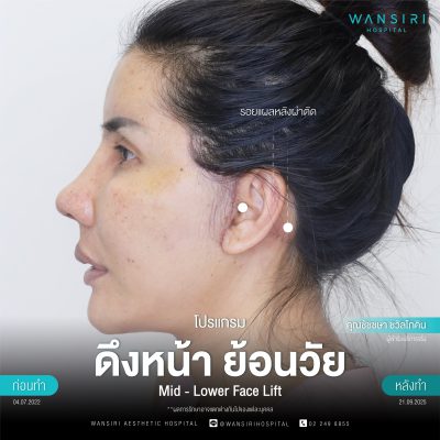 ดึงหน้า, ดึงหน้า ชั้นลึก, Face Lift, Deep Plane Facelift, Neck Lift