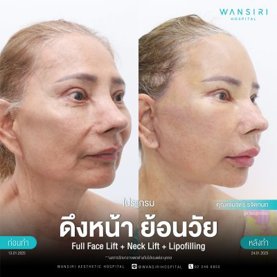 ดึงหน้า, ดึงหน้า ชั้นลึก, Face Lift, Deep Plane Facelift, Neck Lift
