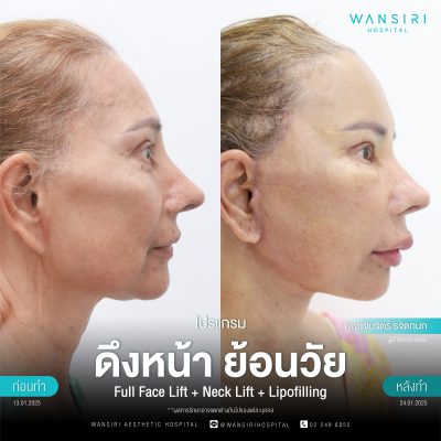 ดึงหน้า, ดึงหน้า ชั้นลึก, Face Lift, Deep Plane Facelift, Neck Lift