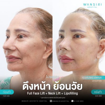 ดึงหน้า, ดึงหน้า ชั้นลึก, Face Lift, Deep Plane Facelift, Neck Lift