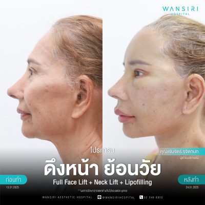 ดึงหน้า, ดึงหน้า ชั้นลึก, Face Lift, Deep Plane Facelift, Neck Lift