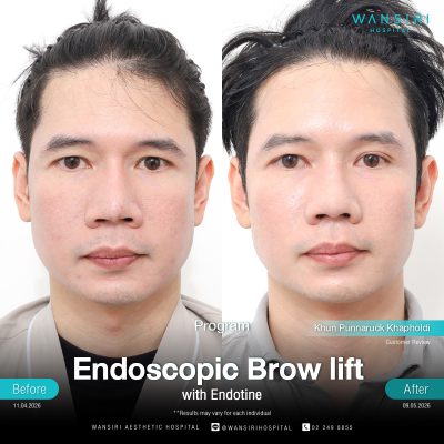 Endoscopic Brow Lift before and after results at Wansiri Hospital Bangkok