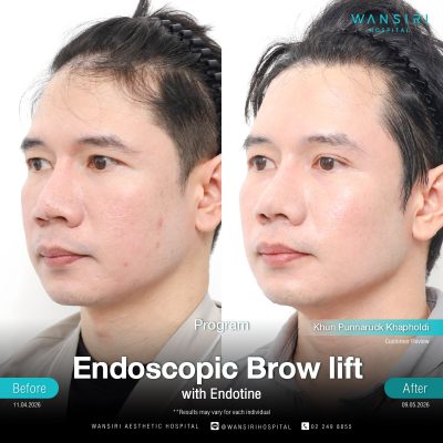 Endoscopic Brow Lift before and after results at Wansiri Hospital Bangkok