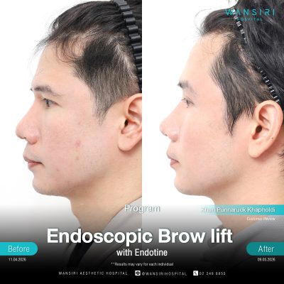 Endoscopic Brow Lift before and after results at Wansiri Hospital Bangkok