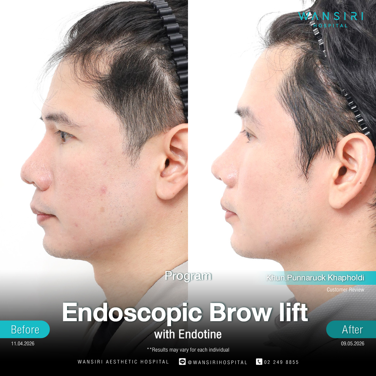 Endoscopic Brow Lift before and after results at Wansiri Hospital Bangkok
