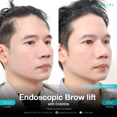 Endoscopic Brow Lift before and after results at Wansiri Hospital Bangkok