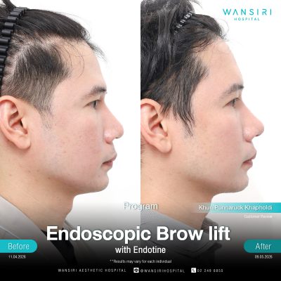 Endoscopic Brow Lift before and after results at Wansiri Hospital Bangkok