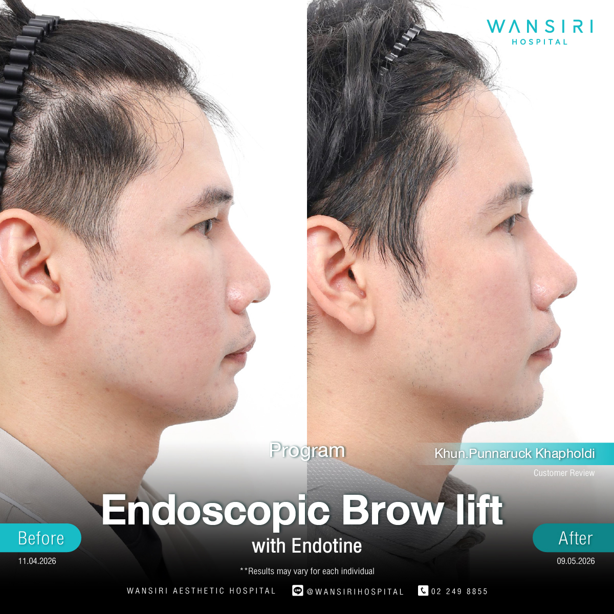 Endoscopic Brow Lift before and after results at Wansiri Hospital Bangkok