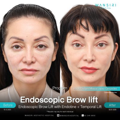 Endoscopic Brow Lift before and after results at Wansiri Hospital Bangkok