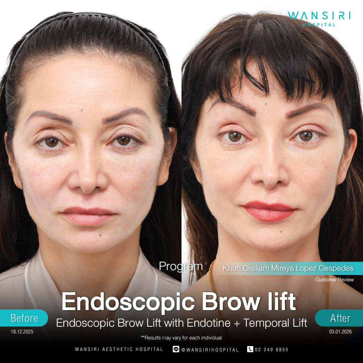 Endoscopic Brow Lift before and after results at Wansiri Hospital Bangkok