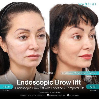 Endoscopic Brow Lift before and after results at Wansiri Hospital Bangkok