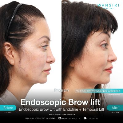 Endoscopic Brow Lift before and after results at Wansiri Hospital Bangkok