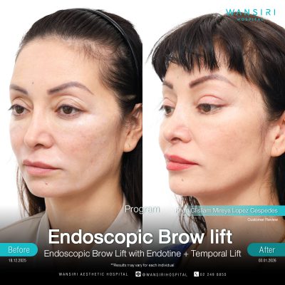Endoscopic Brow Lift before and after results at Wansiri Hospital Bangkok