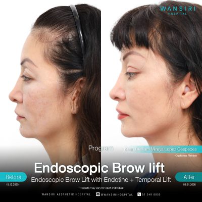 Endoscopic Brow Lift before and after results at Wansiri Hospital Bangkok