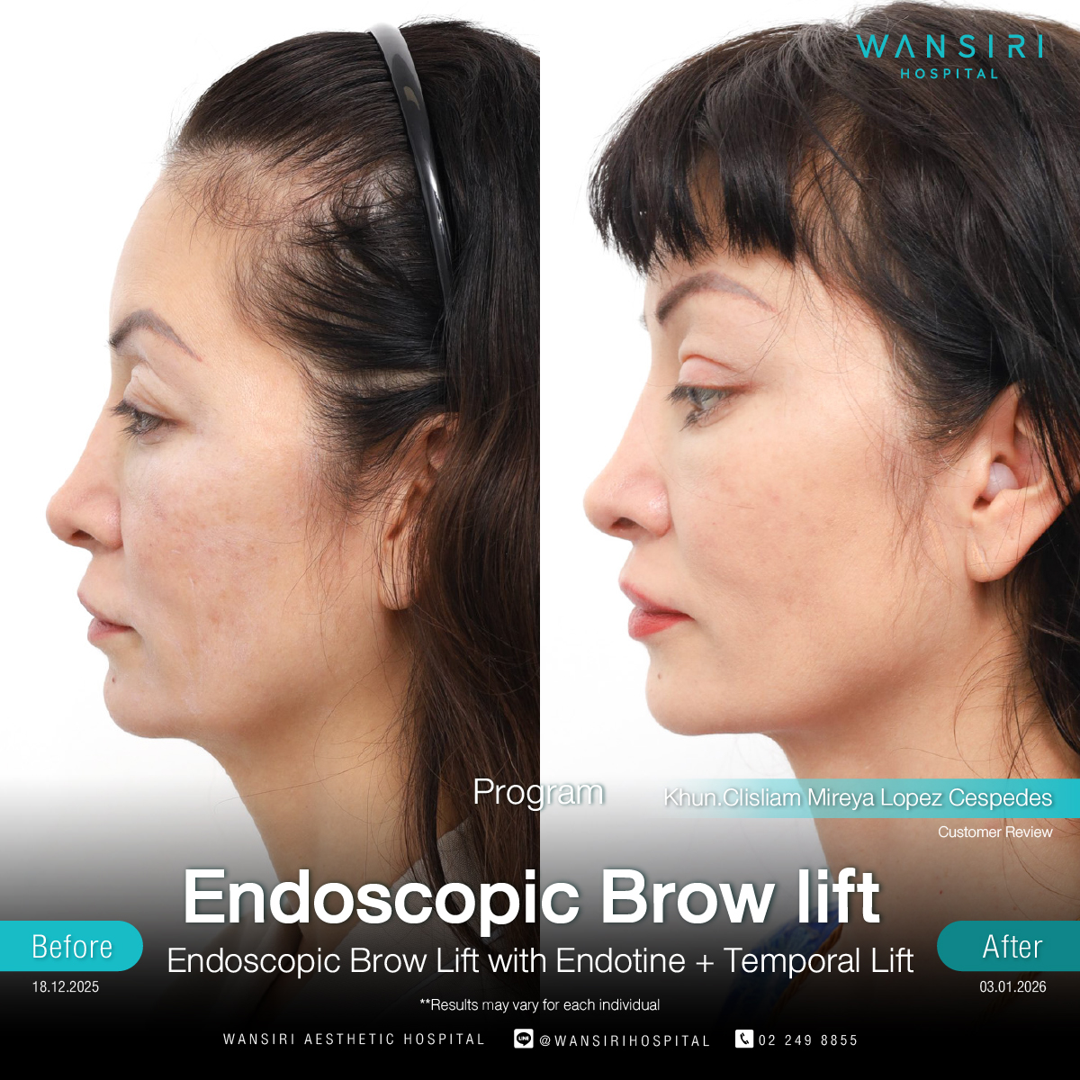 Endoscopic Brow Lift before and after results at Wansiri Hospital Bangkok